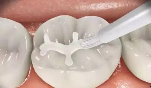 成人龋齿修复过程视频,从诊断到恢复