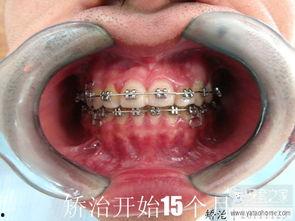 成人拔牙有坏处吗视频,揭秘拔牙的潜在风险与好处